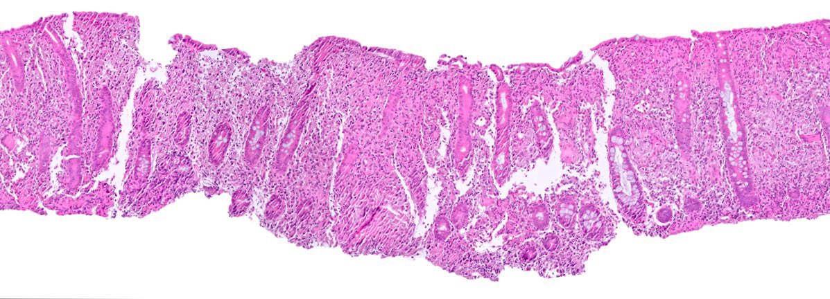 katcollmd's tweet photo. @FridaRosenblum presumed Crohn disease by clinical presentation and endoscopy, no prior biopsies or immunosuppression #pathcritters #surprisemycosis  #pathtwitter 

☝🏼 critical to rule out infection, including fungal, in pts with suspected IBD before starting immunosuppressive therapy https://t.co/oKWbkA86DR