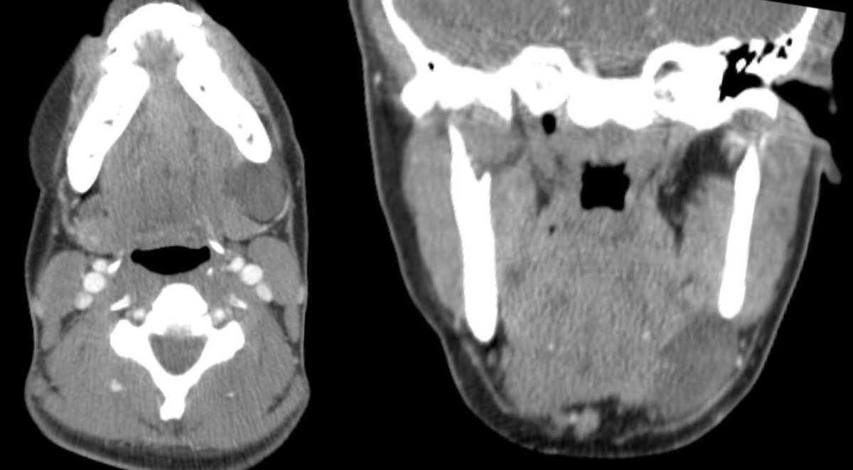 daniel_gewolb's tweet photo. What is the most likely diagnosis in this 25 y/o F presenting w/ palpable soft, mobile enlargement of the left submandibular region? No erythema on exam

More images in 🧵

#MedEd #ENT #medicine #Neurosurgery #radres #futureradres @ASHNRSociety https://t.co/yWd16JKYxr