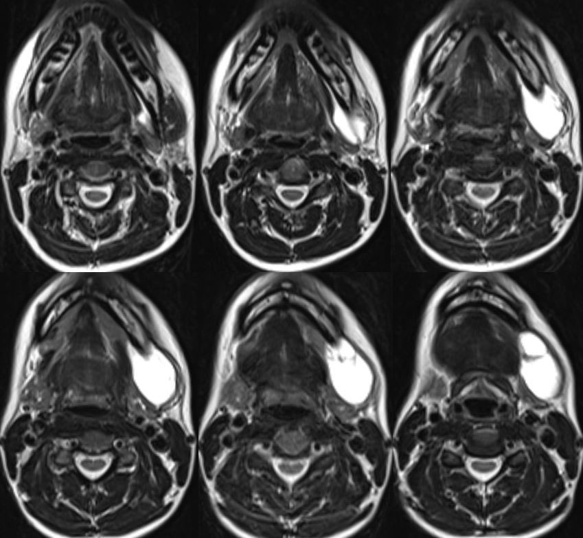 daniel_gewolb's tweet photo. What is the most likely diagnosis in this 25 y/o F presenting w/ palpable soft, mobile enlargement of the left submandibular region? No erythema on exam

More images in 🧵

#MedEd #ENT #medicine #Neurosurgery #radres #futureradres @ASHNRSociety https://t.co/yWd16JKYxr