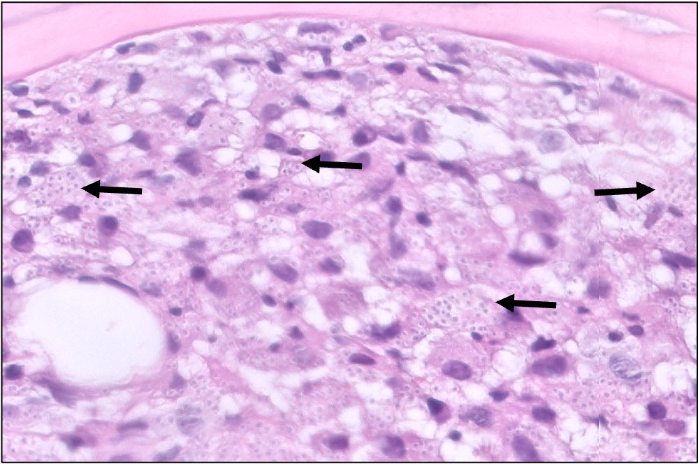 katcollmd's tweet photo. @FridaRosenblum #bonemarrow history of rheumatoid arthritis on methotrexate and Infliximab, admission for fever of unknown origin #pathcritters #surprisemycosis https://t.co/RvIV8yOf0p