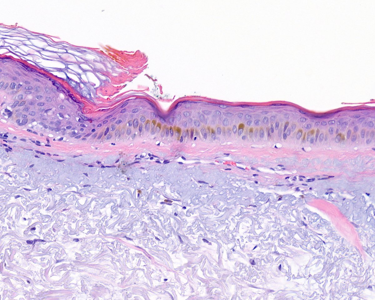 Perfect pigmented porokeratosis