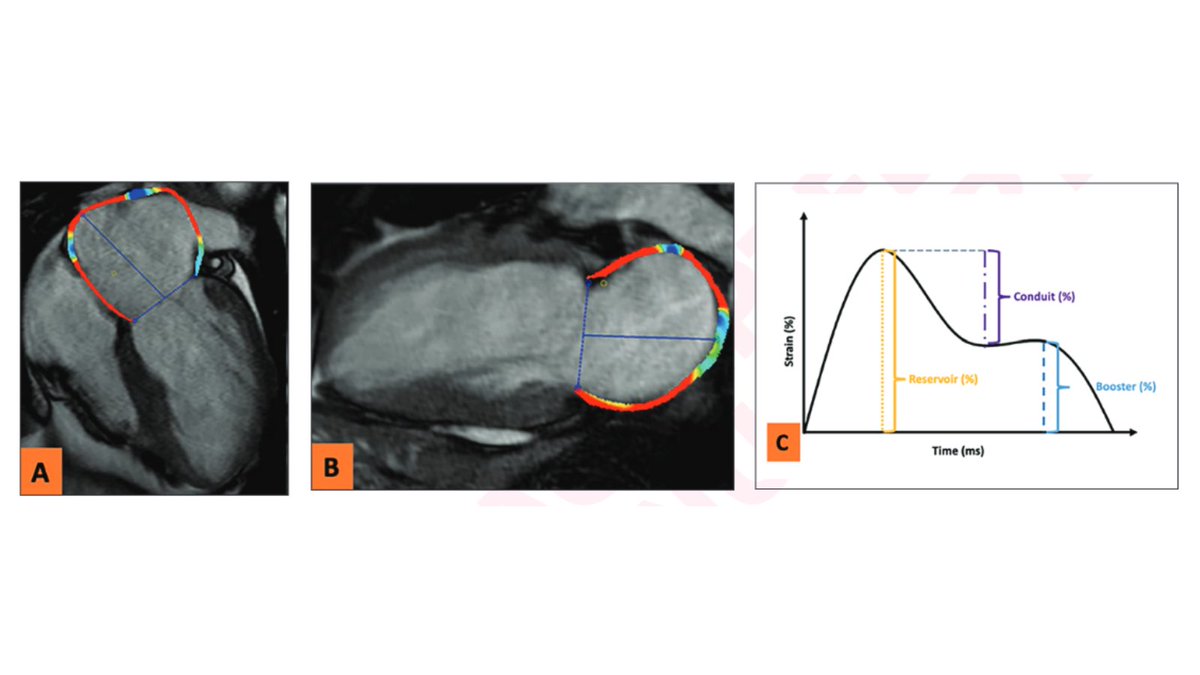 New @AJR_Radiology Accepted Manuscript: 'Prognostic Utility of Left Atrial Strain From MRI Feature Tracking in Ischemic and Nonischemic Dilated Cardiomyopathy: A Multicenter Study' By Drs Fong, Ng, & team @hkumed ajronline.org/doi/10.2214/AJ…