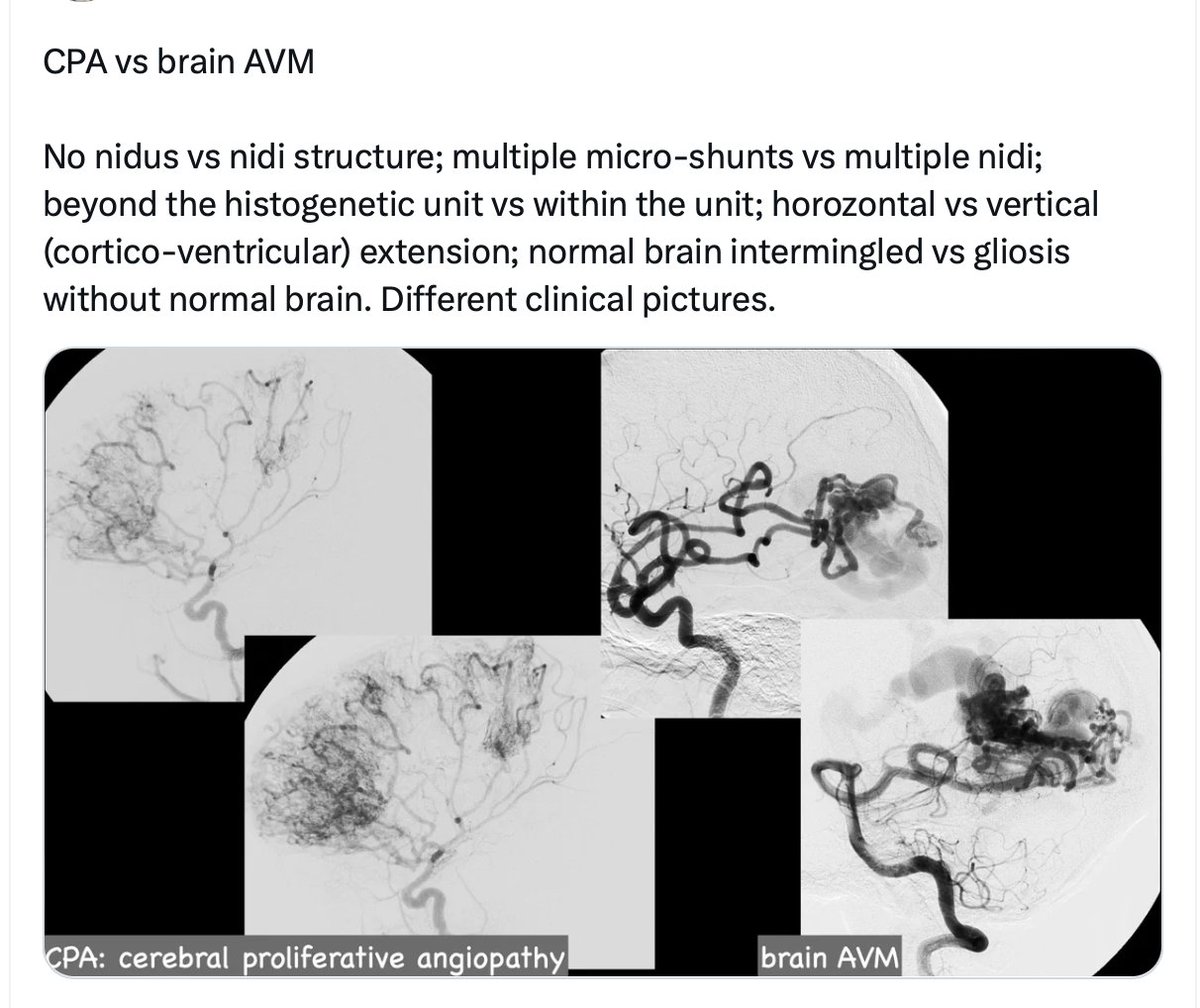 Cerebral proliferative angiopathy (CPA) and brain AVM are essentially different entities, but their differential Dx is often complicating. There is no definite treatment for CPA at present including bypass surgery. Anti-angiogenesis medical Tx will be  hopefully effective for it.