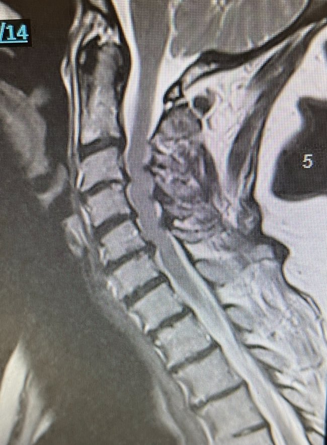 71 yo, cervical spinal cord impingement- this patient saw some surgeons who recommended anterior or posterior fusion, both reasonable options, but to me, this MRI screams LAMINOPLASTY,motion preserving procedure to increase diameter of the spinal canal #MedTwitter #spinesurgery