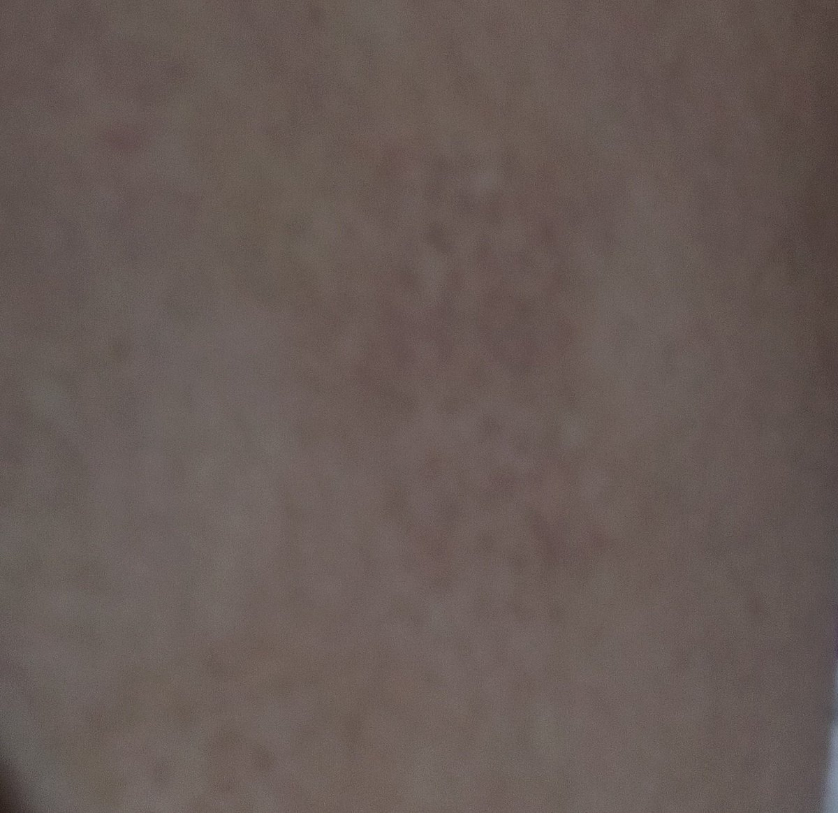 Extraño quemqrme la piel con hielo y sal 😿 solo tengo pequeñas marcas ☹️☹️☹️