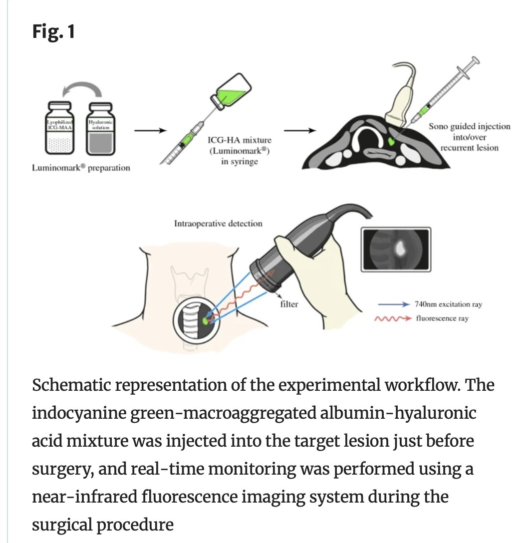 PUBLISHED: The Efficacy and Safety of an #IndocyanineGreen-MacroaggregatedAlbumin-HyaluronicAcid Mixture (LuminoMark™) for Surgical Localization of Recurrent #ThyroidCancer. rdcu.be/dx6RT