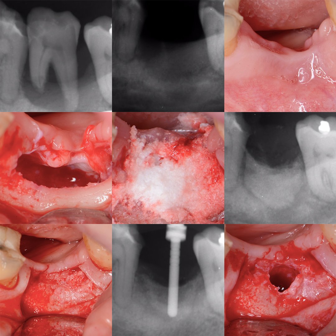 EthossCo's tweet image. Check out this case study from Dr Peter Fairbairn.

Have any questions? Ask him in the EthOss Case Studies Group - hubs.la/Q02kl9LK0

#ethosscasestudies #dentalimplantcasestudy #ethossbonegraft #dentalbonegraft #growstronger #dentalimplantcommunity