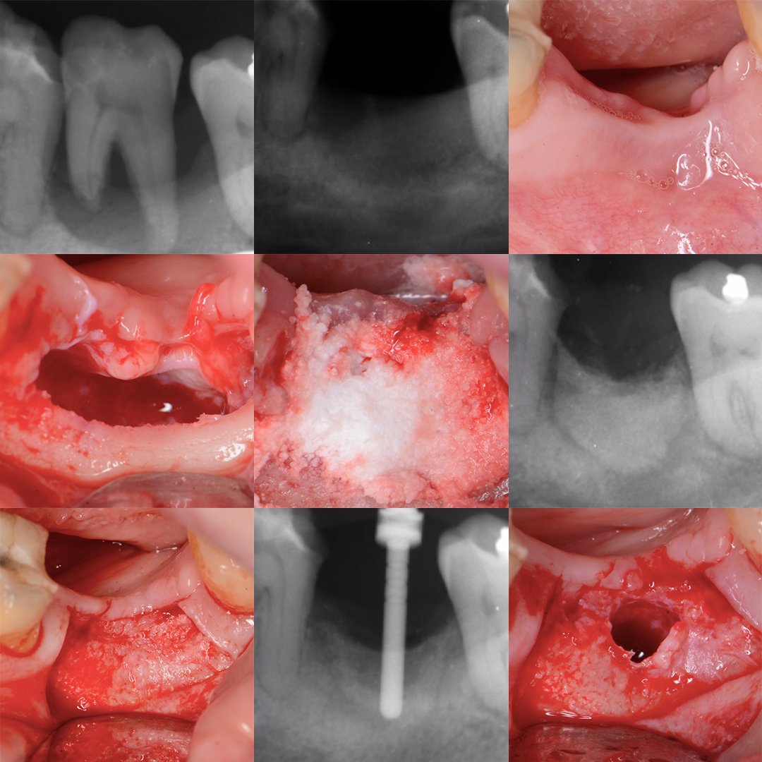Check out this case study from Dr Peter Fairbairn.

Have any questions? Ask him in the EthOss Case Studies Group - hubs.la/Q02kl9LK0

#ethosscasestudies #dentalimplantcasestudy #ethossbonegraft #dentalbonegraft #growstronger #dentalimplantcommunity