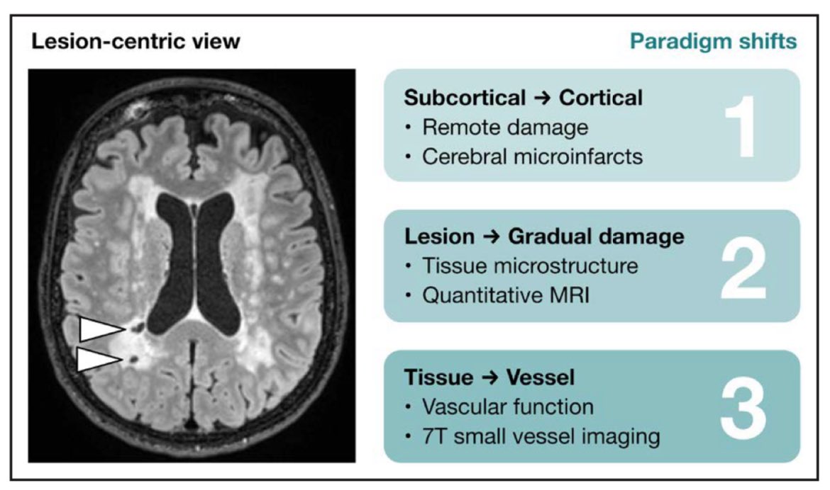 Cerebral Small Vessel Disease: Advancing Knowledge With Neuroimaging | Stroke ahajournals.org/doi/10.1161/ST… #AHA_Centennial