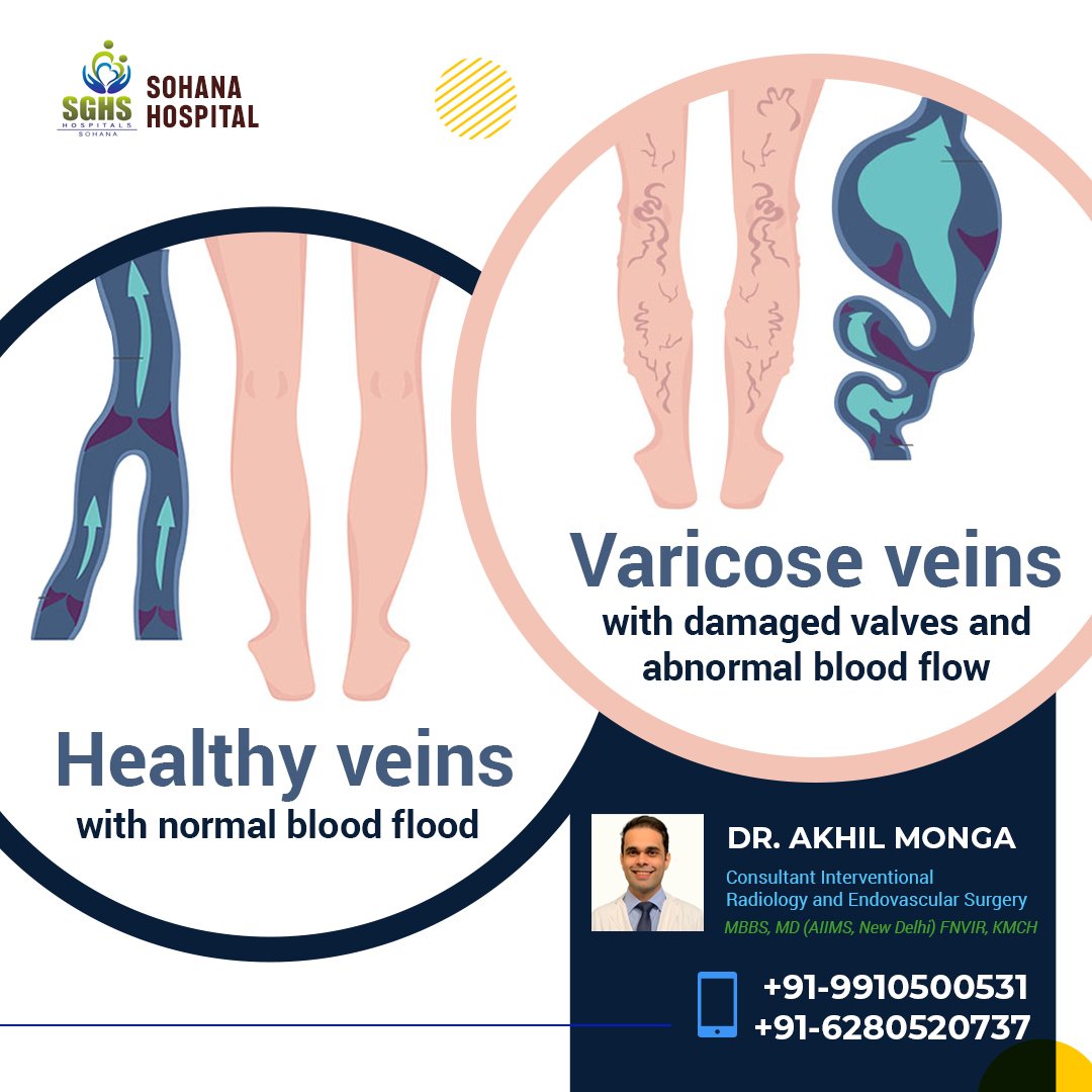 Varicose veins are a condition that usually affects the leg veins. In this, the veins of the legs become twisted and enlarged. This can cause discomfort to patients and is also of cosmetic concern. bit.ly/3X0x64x #Varicoseveins #cosmeticconcern #varicoseveinstreatment