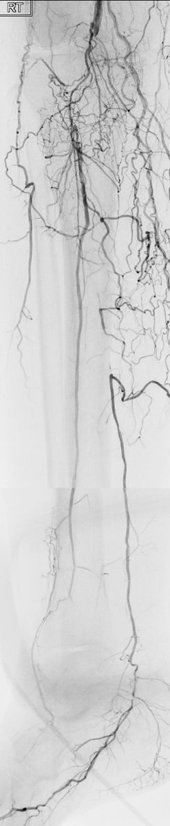 72 y 5th toe OM to be removed, recent sub rec into the peroneal (no stenting), done by other operator, which acutely reoccluded. What would you do now? @FadiSaab17 @kmadass @DonGarbettMD @drcostantino1 @EricSecemskyMD @SDhandMD @docTPlive @t_intheleadcoat @Watts_IR @monteromiguel