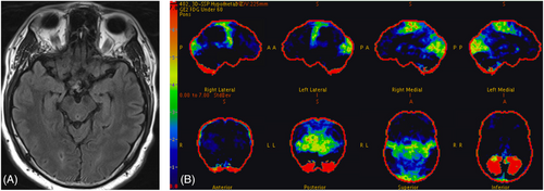 What is abnormal on this #neuroimaging? Read the throwback Thursday article below to find out and save a #brain! #encephalitis #neurology #neurotwitter #neurotwitternetwork @dralicehan #IDPhoeniX #IDTwitter #neuroradiology #radres #futureneurologist onlinelibrary.wiley.com/doi/10.1111/jo…