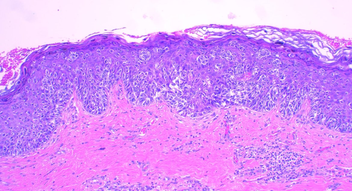 Pagetoid spread #melanoma #skintumor #skin #medicine #pathology #patología