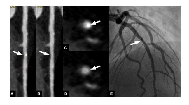 In-vivo virtual noncalcium with #photoncounting #yesCCT -> Improved stenosis grading on noncalcium images Fantastic collaboration with ccm.mc shorturl.at/int07 @mergen_v @MatthEberhard @rmanka_ @alecandreva @rengadr @CardioZurich @RadiologieUSZ