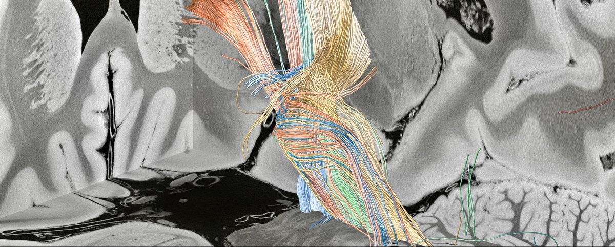 Andreas Horn (@andreashorn_) on Twitter photo Super excited that our dysfunctome paper is finally out at <a href="/NatureNeuro/">Nature Neuroscience</a>!
Certainly by far the most important work I have been involved in so far.
Huge congratulations and kudos to <a href="/b_hollunder/">Barbara Hollunder</a> and <a href="/NingfeiL/">Ningfei Li</a> for seeing this through. Fantastic tweetorial by Barbara below 👇👇 Super excited that our dysfunctome paper is finally out at <a href="/NatureNeuro/">Nature Neuroscience</a>!
Certainly by far the most important work I have been involved in so far.
Huge congratulations and kudos to <a href="/b_hollunder/">Barbara Hollunder</a> and <a href="/NingfeiL/">Ningfei Li</a> for seeing this through. Fantastic tweetorial by Barbara below 👇👇