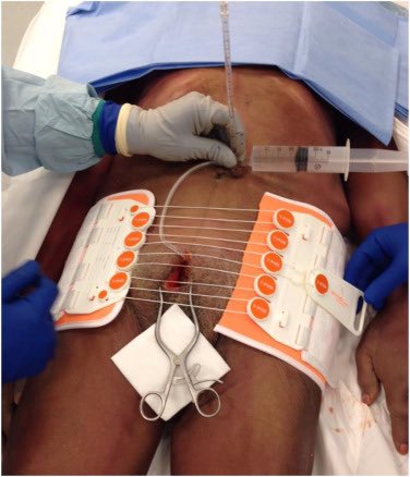 emergencyclub1's tweet photo. Do Prehospital Applied Pelvic Binders Impact Mortality?

📊 Patient Cohorts: Three groups - 14 with appropriately applied binders, 14 with inappropriately applied binders, and 38 without binders.

💡 Key Findings: Survival rates were 92% with binders and 81% without, but this difference was not statistically significant.

🔍 Conclusion: Pelvic binders did not significantly affect outcomes for patients with unstable pelvic fractures. Injury Severity Score (ISS) was a more significant survival predictor.