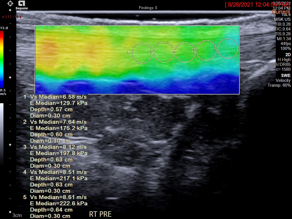 Sports Health: A Multidisciplinary Approach (@sports_health) on Twitter photo Shear Wave Elastography is a non-invasive imaging modality that can be used 2 evaluate tendon stiffness & elasticity, as seen in female collegiate athletes with higher baseline Achilles tendon stiffness compared 2 nonathletes. @UAV_Ortho <a href="/BCW137/">Brian Werner</a>
Link: ow.ly/t0ow50Qrveu Shear Wave Elastography is a non-invasive imaging modality that can be used 2 evaluate tendon stiffness & elasticity, as seen in female collegiate athletes with higher baseline Achilles tendon stiffness compared 2 nonathletes. @UAV_Ortho <a href="/BCW137/">Brian Werner</a>
Link: ow.ly/t0ow50Qrveu
