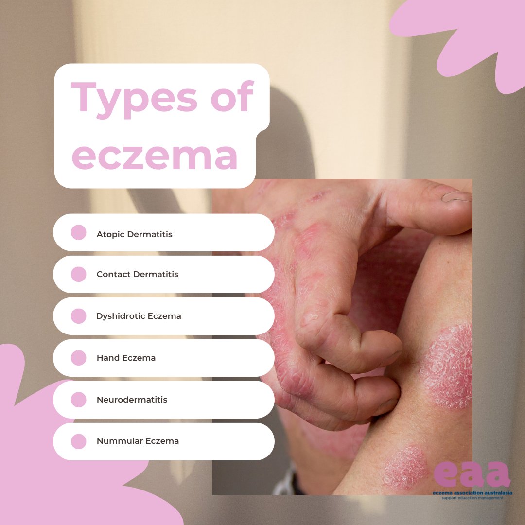 Did you know there is more than one type of eczema? 

Ensuring you have a professional diagnosis from a doctor or dermatologist can help inform what treatments will be most effective in managing your symptoms. 

#EAA #eczema #eczematreatment