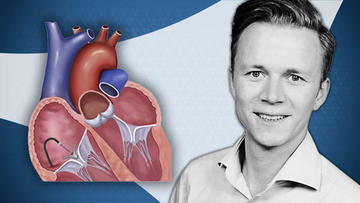 In episode 3⃣ of this #PCRtricuspid educational series @kp_rommel shares insights on #physiology relevant to diagnosing and treating TR-related right #heartfailure. In this video you will learn about: 🔵the theoretical implications of TR reduction for RV performance 🔵the…