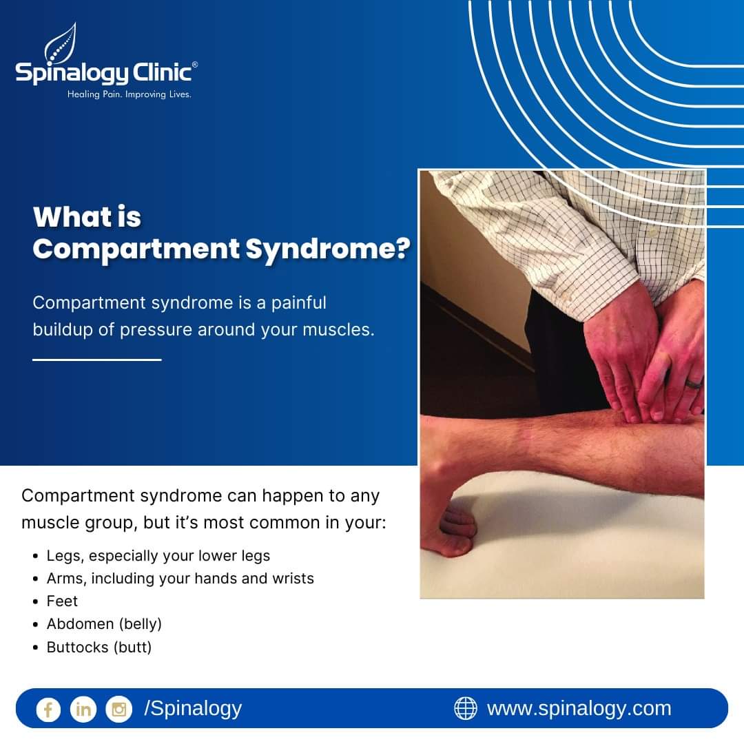 What is Compartment Syndrome?

Compartment syndrome is a painful buildup of pressure around your muscles.

#Spinalogy #SpinalogyClinic #MusclePain #Pain #CompartmentSyndrome #Painfree