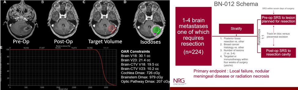 · 2nd case resected large brain metpost-op SRS (27/3) · Risk LMD pre-op SRS ~6% vs. post-op ~20% · Pertinent ongoing trial NRG BN012 pre vs. post-op SRS @stuxrt