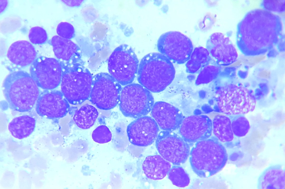 85984's tweet photo. 👉 Cytopathology image of Burkitt  lymphoma in a 13 years old boy. Thanks

#Pathoutpic
#pathoutpic
#PathTwitter https://t.co/nnsIVhBN35
