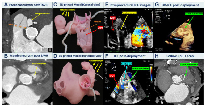 In this #JACC article, @adnanalkhouli @JuanCrestanello & A. Al-Abcha, MD review 3D-ICE–Guided Repair of a Persistent LVOT Pseudoaneurysm After Aortic Valve Replacement: An Icy Seal! bit.ly/3uF3D6Y