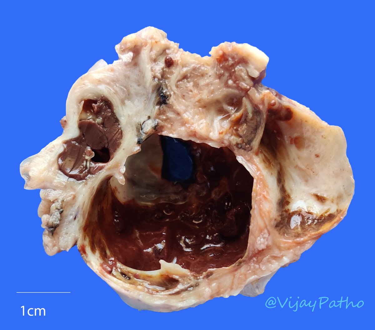 VijayPatho's tweet photo. 31/F Guess? #Gynepath #PathClassic #grossognosis #pathology #pathart
@JMGardnerMD @smlungpathguy  @kriyer68
@DrAhmedKalebi @DrGeeONE  @Thejaspatho
@vi_monappa @Baskotacytopath @ariella8
@TristanRutland7 @erikanuradha @Gagandeepk5MD
@Swathiprabhu5 @archibhat3 @MAHoureih
@ariella8 https://t.co/7xYKkVx6yo