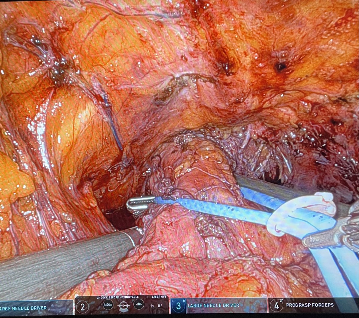 Joyous moment when the cardiere forceps was able to pass from R to L yesterday in this robotic female AMS800 implant,in a pt w 5 previous mesh, Burch & PF surgeries. Leak test negative 😅Thk you to my mentors @BPeyronnet @echartierkastle @gilkarsenty @bsc_urology @WayneLam_Urol