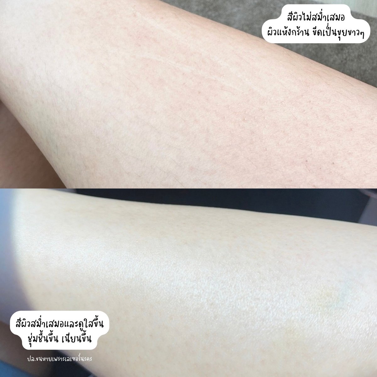 ZeibabReview's tweet photo. โดนป้ายยามา โลชั่นตัวใหม่ Eucerin Spotless Body lotion สูตร ใส่ไทอามิดอล ที่เน้นช่วยให้ผิวกระจ่างใส ก่อนหน้าไปเที่ยวออกแดดแล้วไม่ได้ทากันแดดผิวขิตเลยจ้า คล้ำขึ้น เป็นจุดไม่สม่ำเสมอ ได้ตัวนี้ฮีลไว้ ใช้ต่อเนื่องแล้วสีผิวดูสม่ำเสมอ ผิวชุ่มชื้น ใสขึ้น 

ให้ดูผิวส่วนขาเราน่าจะเห็นชัดสุด ก่อนหน้าผิวเสีย แห้งกร้าน ขีดเป็นขาวๆ แล้วสีผิวไม่สม่ำเสมอเลย พอใช้โลชัน Eucerin ทาเช้า-เย็นต่อเนื่องน่าจะเกือบๆสองวีค ช่วยกู้ผิวเราได้เยอะ รู้สึกได้เลยว่าผิวดีขึ้นอะ สีผิวสม่ำเสมอและดูใสขึ้น ชุ่มชื้นขึ้น เนียนขึ้นด้วย ใครที่โดนแดดเยอะๆจนผิวคล้ำเสียตอบโจทย์มาก ลอง!

ปล.ไม่ได้ปรับสี ปรับแสงรูปน้าาาาา โดยรวมคือพอใจผลลัพธ์เลยคับ✨#ใช้ดีบอกต่อ #โลชั่นผิวไบรท์