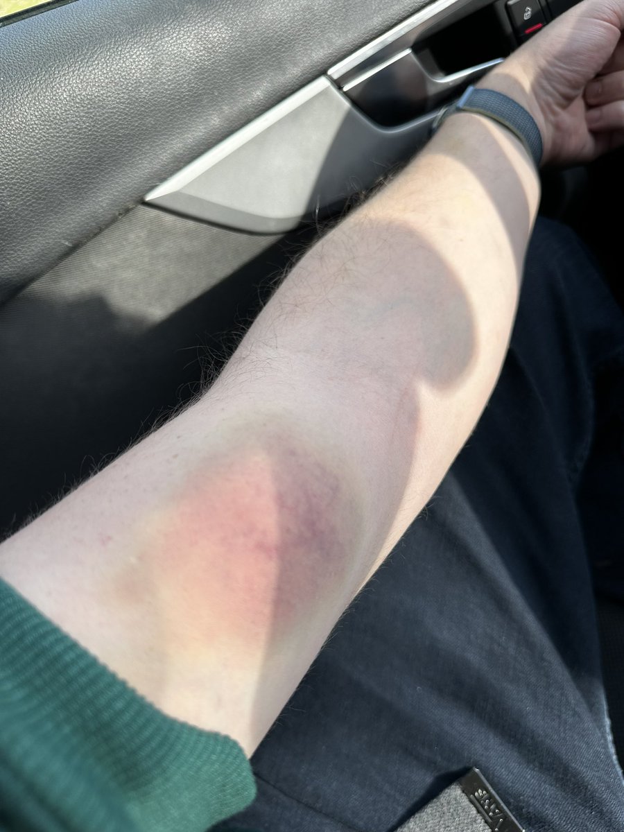 sidv69lpz's tweet photo. Wie anfällig bist du für blaue Flecke?

Ich: https://t.co/xpDmQxMTy8