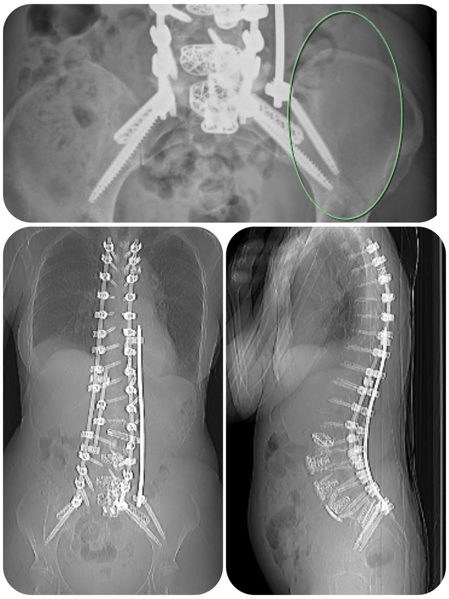 A nice touch from Dr Mike Wilks and RadiologySA circling the area on my patient’s X-Ray where he felt I could have put even more metalwork 😜 #titaniumdeficiencyisreal (Full series to follow later) #spine #spinesurgery #neurosurgery #orthopaedicsurgery #orthopedics #scoliosis