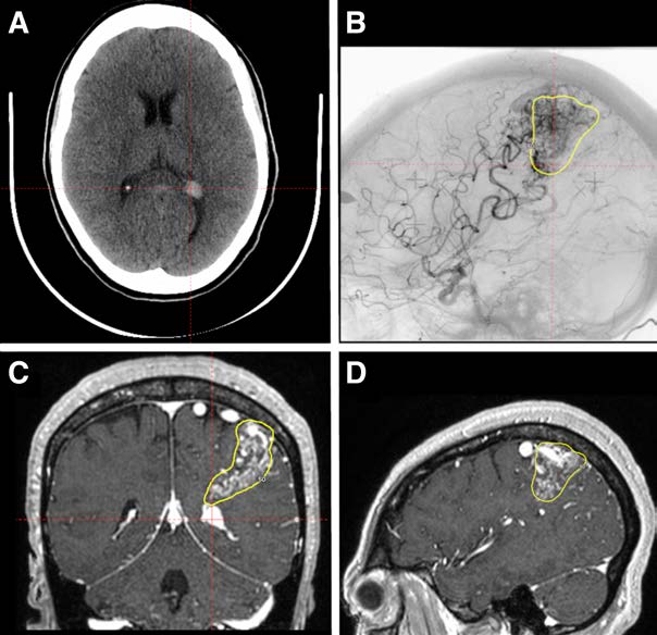 Stroke AHA/ASA (@strokeaha_asa) on Twitter photo Illustrative Teaching Case: There may be an increased risk of AVM rupture associated with straining in patients with IBS, showcasing the need for a holistic approach to patient management in order to reduce this risk. ahajrnls.org/3URs9fJ <a href="/Obinalamer/">Othman Bin-Alamer</a> <a href="/hadjiMDPhD/">Costas Hadjipanayis</a> <a href="/haboualshaar/">Hussam Abou-Al-Shaar</a> Illustrative Teaching Case: There may be an increased risk of AVM rupture associated with straining in patients with IBS, showcasing the need for a holistic approach to patient management in order to reduce this risk. ahajrnls.org/3URs9fJ <a href="/Obinalamer/">Othman Bin-Alamer</a> <a href="/hadjiMDPhD/">Costas Hadjipanayis</a> <a href="/haboualshaar/">Hussam Abou-Al-Shaar</a>