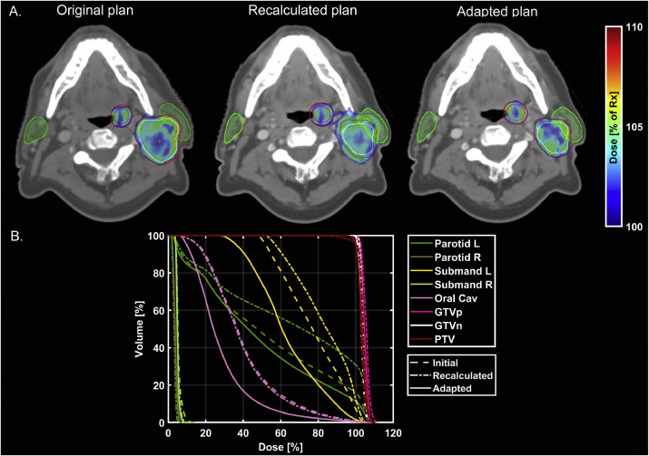 ☢️LINAC-based adaptive #radiotherapy (ART) for #headandneckCancer reduced doses to critical salivary structures & oral cavity. Automated CBCT tracking provided anatomic change info that may aid identifying which patients may be good ART candidates. #hncsm
sciencedirect.com/science/articl…