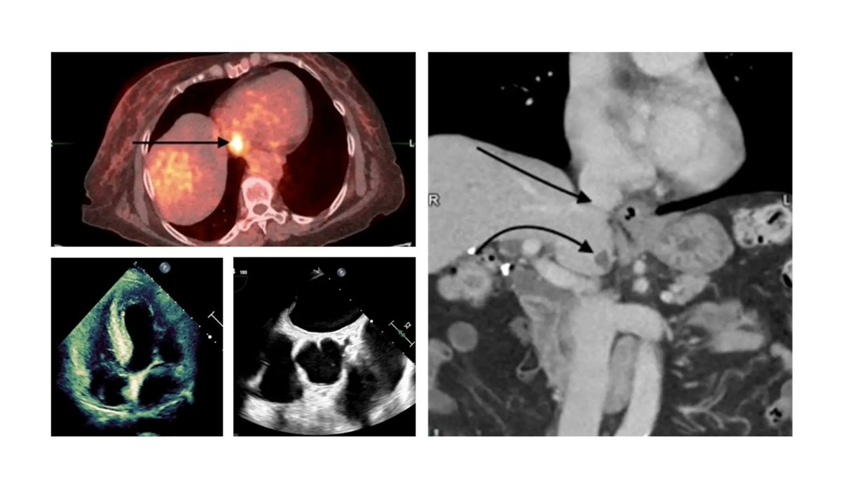 Heart Anatomy Quirk Leads to False Tumor Alarm in Imaging - sciencefeatured.com/2024/02/21/hea… #CardiacImaging #PET/CT #CristaTerminalis #sciencefeatured #sciencenews