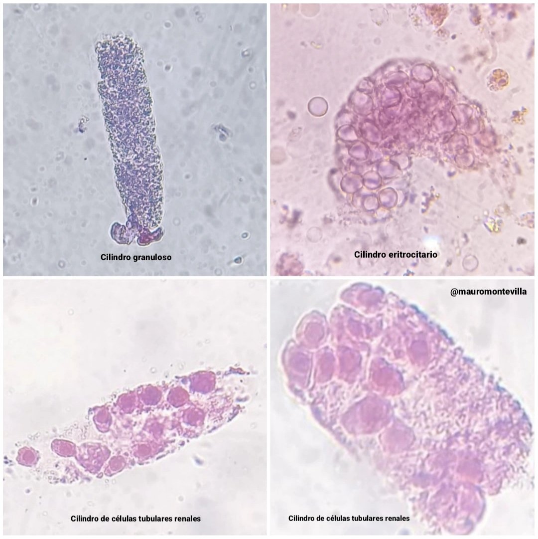 Diferentes tipos de cilindros.

#SedimentoUrinario #UrinarySediment #UrinaryMicroscopy