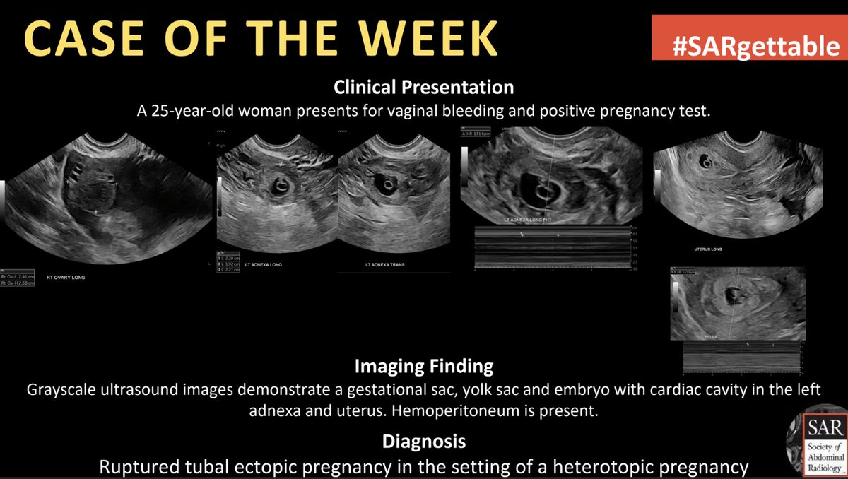 The answer to last week's #SARgettable Case of the Week is: Ruptured tubal ectopic pregnancy in the setting of a heterotopic pregnancy. Thanks for playing!