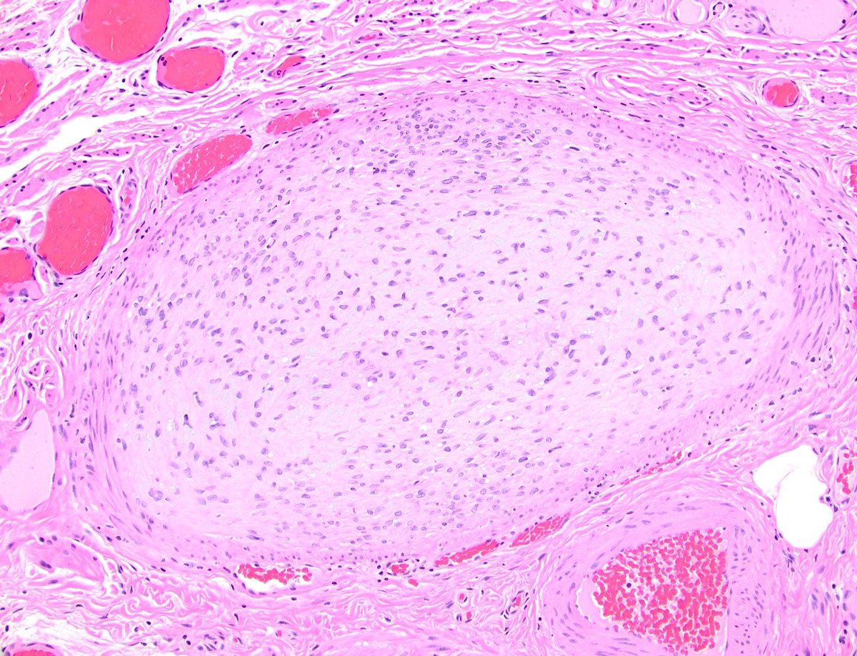 Has anyone ever seen a thrombosed vessel in a fallopian tube?
#gynpath