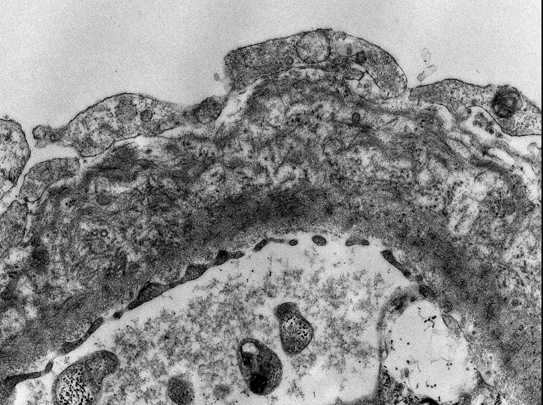 JZRenalPath's tweet image. Nice example of fibrillary GN with prominent sub-epithelial fibril accumulation (sort of mimicking MN). IgG &amp;amp; DNJAB9 stains are pictured. Pt biopsies for CKD with heavy proteinuria. #renalpath #pathtwitter #nephropath