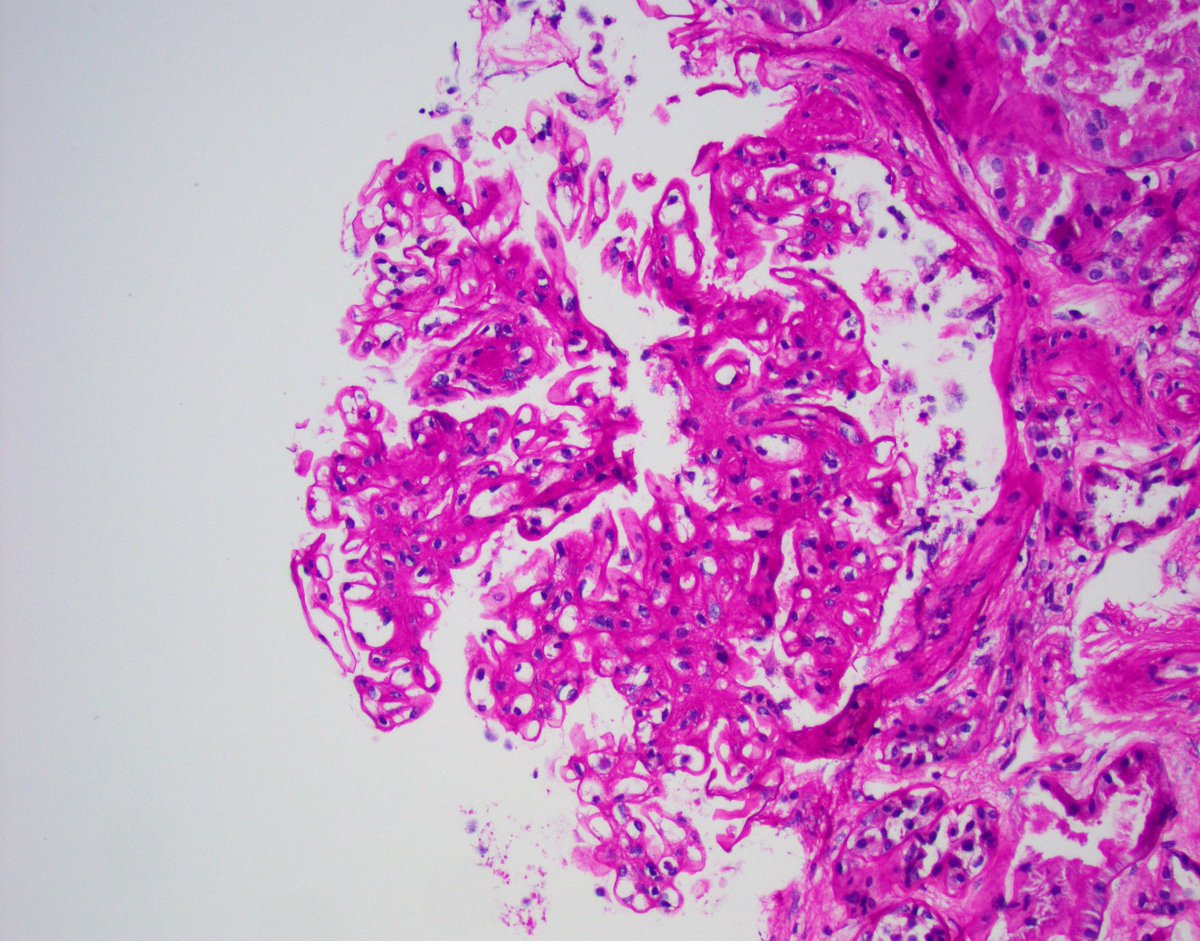 JZRenalPath's tweet image. Nice example of fibrillary GN with prominent sub-epithelial fibril accumulation (sort of mimicking MN). IgG &amp;amp; DNJAB9 stains are pictured. Pt biopsies for CKD with heavy proteinuria. #renalpath #pathtwitter #nephropath