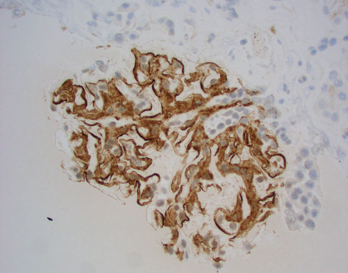 JZRenalPath's tweet image. Nice example of fibrillary GN with prominent sub-epithelial fibril accumulation (sort of mimicking MN). IgG &amp;amp; DNJAB9 stains are pictured. Pt biopsies for CKD with heavy proteinuria. #renalpath #pathtwitter #nephropath