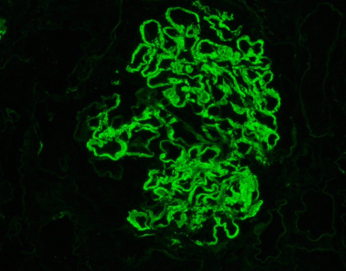 JZRenalPath's tweet image. Nice example of fibrillary GN with prominent sub-epithelial fibril accumulation (sort of mimicking MN). IgG &amp;amp; DNJAB9 stains are pictured. Pt biopsies for CKD with heavy proteinuria. #renalpath #pathtwitter #nephropath