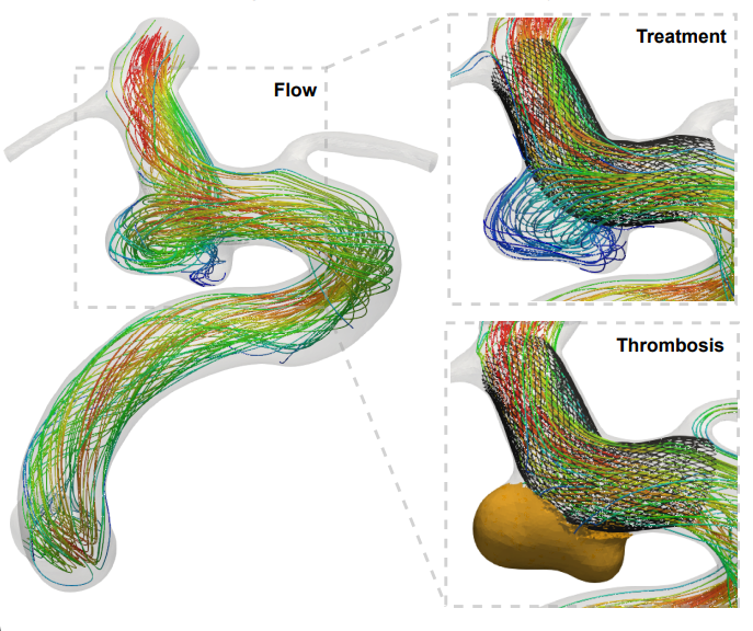 🚀 New review from @UoMPankhurst showcases a leap in blood flow simulation tech! This could revolutionize vascular disease treatment, offering custom-fit medical devices & real-time surgical insights. A healthier future is on the horizon! 🩺 
#MedicalInnovation #VascularHealth…