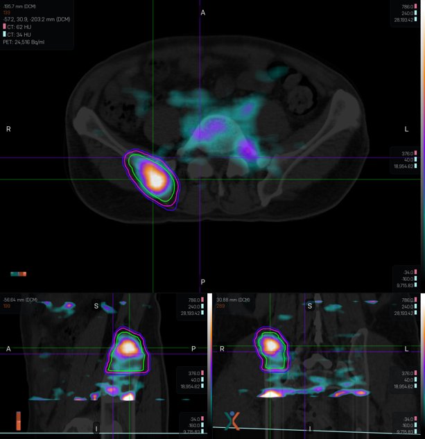 TeWilliamsMD's tweet photo. 2nd patient starting #SBRT with #BgRT PET-guided radiation! We are getting better at this, and bone metastasis works well with bright FDG signal. Great job Dr. Li, Dr. Liu, Dr. Watkins, and team! @cityofhope @COH_RadOnc https://t.co/1kL7yAS7yh