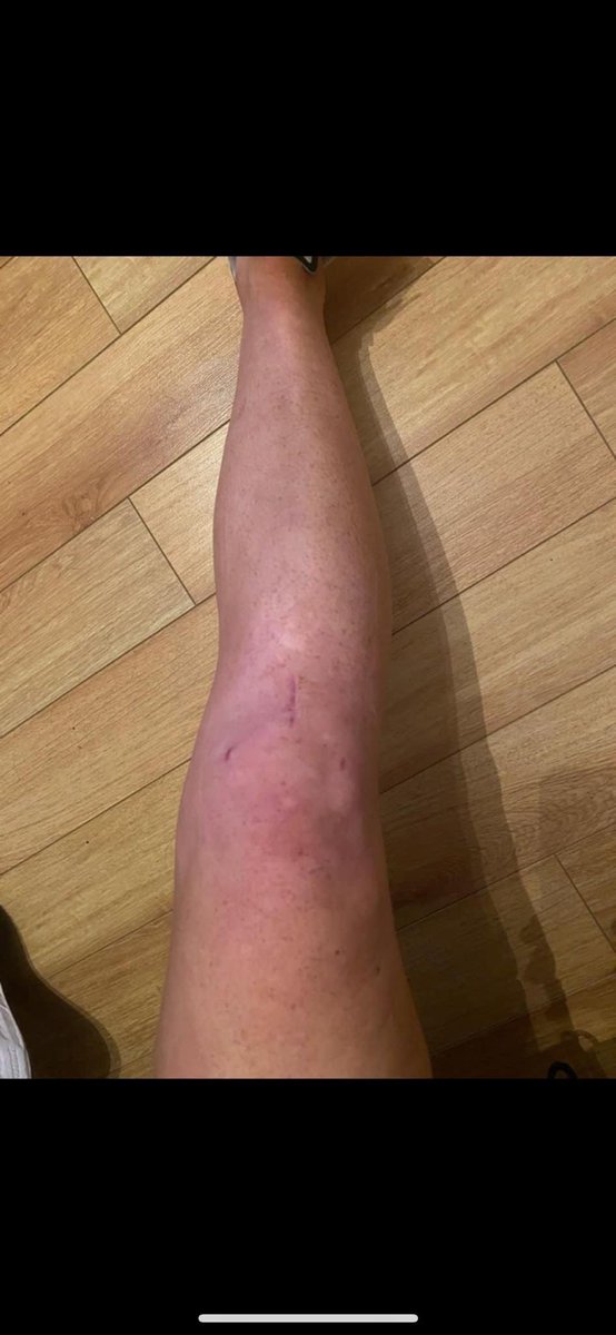 NWgameready's tweet image. Book your game ready early and enjoy the benefits of accelerating your recovery ❤️‍🩹.
Give yourself the best Recovery ❤️‍🩹 

#acl #munsterrugby #coldcompression #aclrehab #aclreconstruction #irelandrugby #orthopedics #kneereplacement #physio #physiotherapist