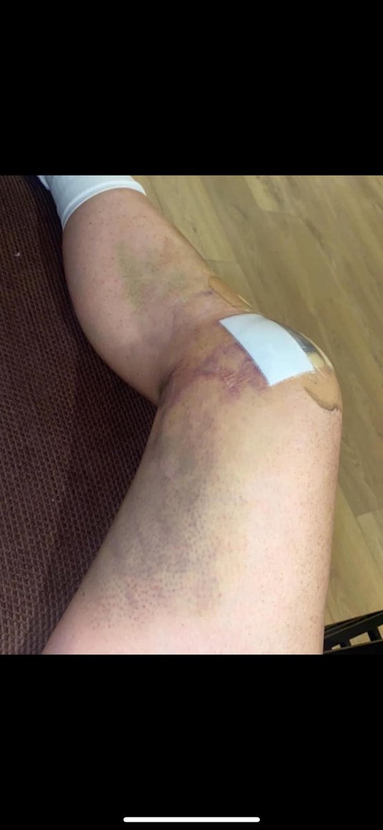 NWgameready's tweet image. Book your game ready early and enjoy the benefits of accelerating your recovery ❤️‍🩹.
Give yourself the best Recovery ❤️‍🩹 

#acl #munsterrugby #coldcompression #aclrehab #aclreconstruction #irelandrugby #orthopedics #kneereplacement #physio #physiotherapist