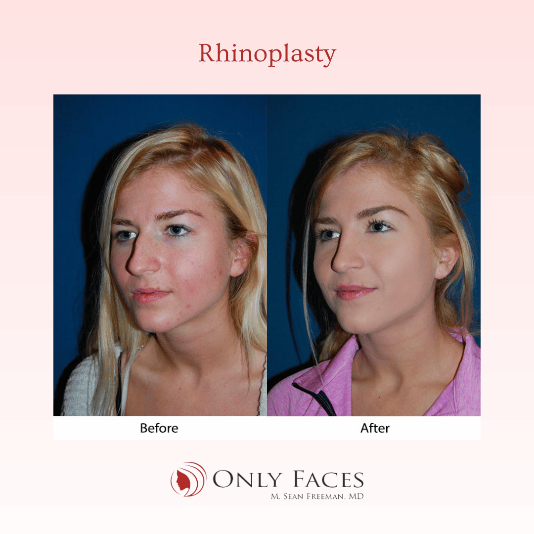 OnlyFacesCLT's tweet photo. This 20-year-old is 1 year post-op from a #Rhinoplasty. #OnlyFaces https://t.co/CMeEq2MTKy