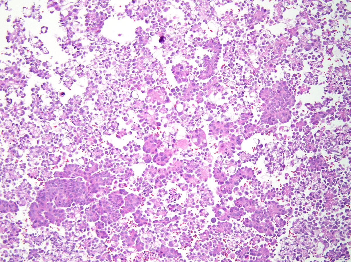 sza_jhcyto's tweet image. “Rings and Hobnails” , all sizes - Metastatic Gastric Adenocarcinoma in Pleural Fluid (Cell block)