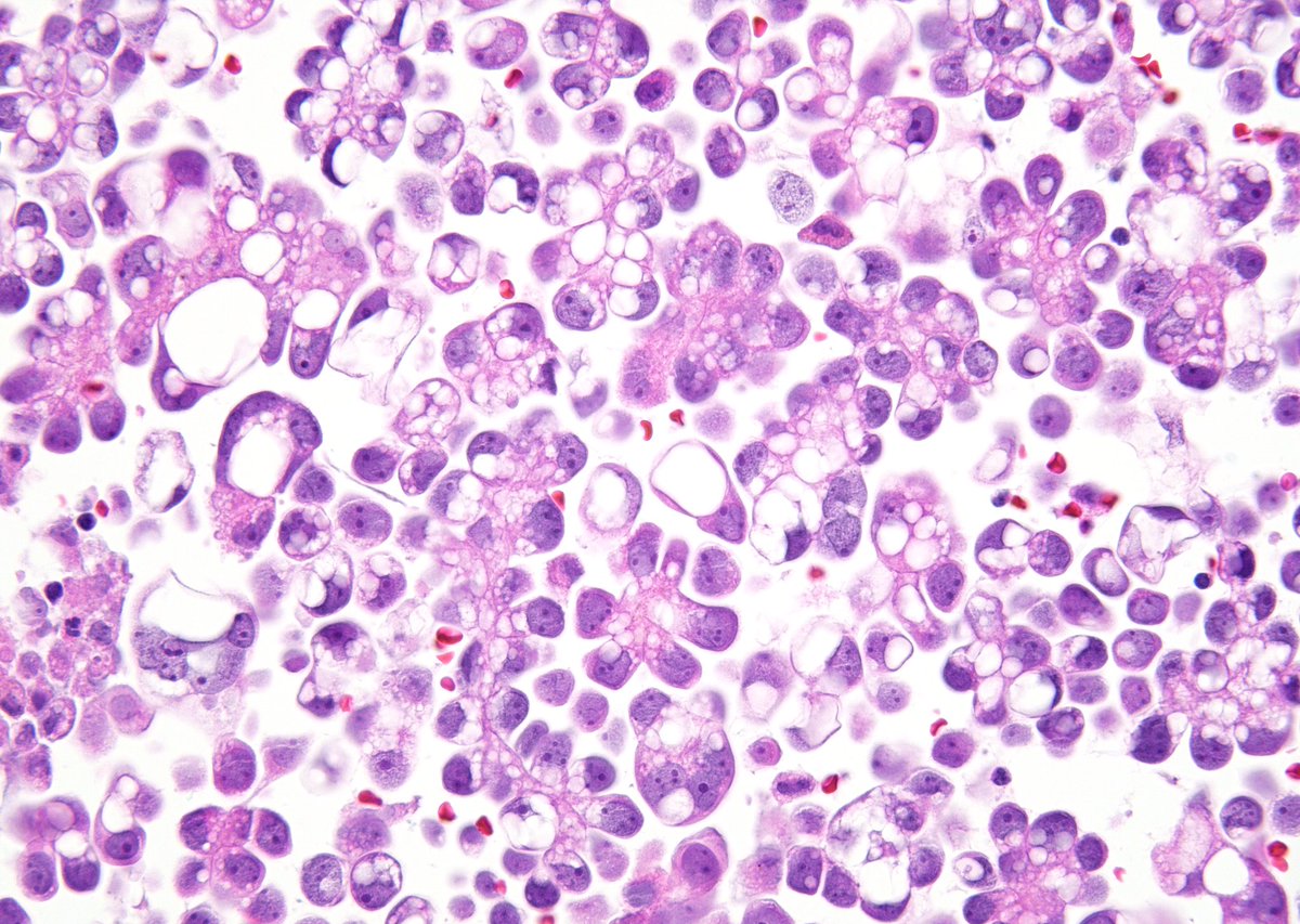 sza_jhcyto's tweet image. “Rings and Hobnails” , all sizes - Metastatic Gastric Adenocarcinoma in Pleural Fluid (Cell block)