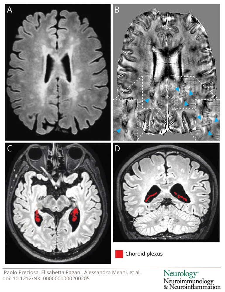 Paramagnetic rim lesions and choroid plexus enlargement may contribute to the pathophysiology of cognitive impairment and fatigue in MS: bit.ly/49AN8rp

#NeuroTwitter #MultipleSclerosis